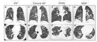 Telomere-Related Lung Fibrosis is Diagnostically Heterogeneous but Uniformly Progressive